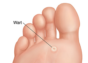 warts on foot left untreated semne de infecție cu helmint pentru copii